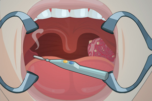 扁桃体手术中文版