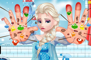 为艾尔莎治疗双手