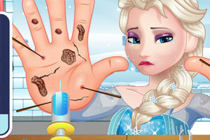 为艾尔莎治疗双手