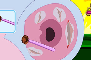 布茨的耳部手术